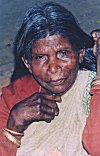 She suffers from leprosy, hence requires public help.